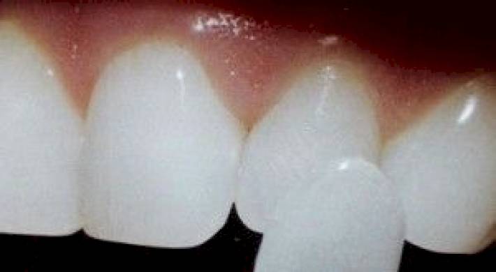 Виниры – проблема стоматологии и обман пациентов